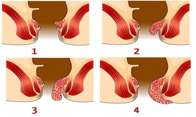jak vypadají hemoroidy v různých fázích
