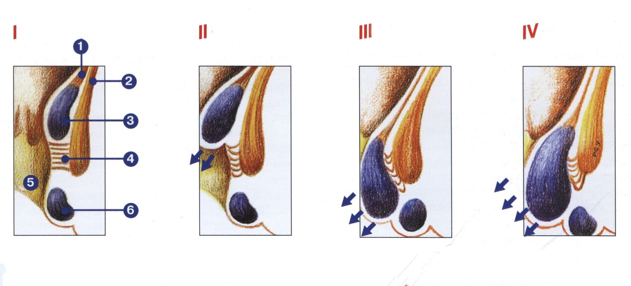 stádia vývoje hemoroidů